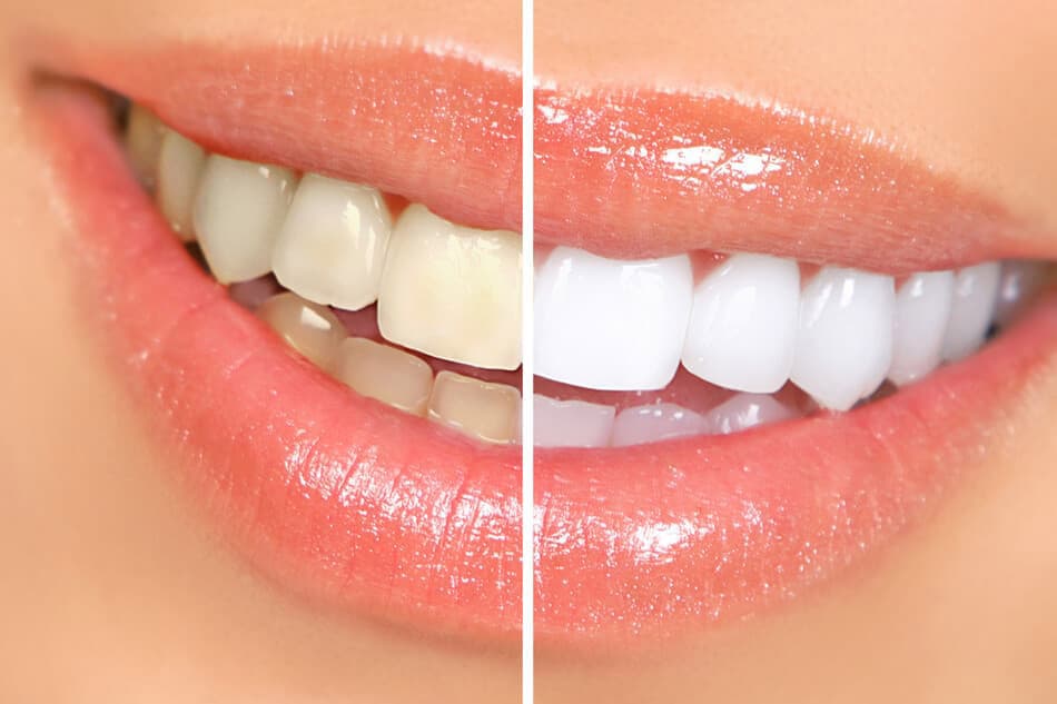 Blanqueamiento dental